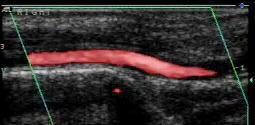 Normal artery at the ankle 